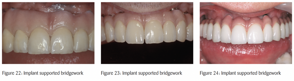 The timeless principles behind predictable full-mouth reconstruction