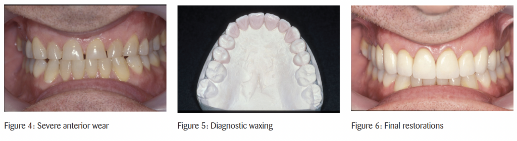 The timeless principles behind predictable full-mouth reconstruction